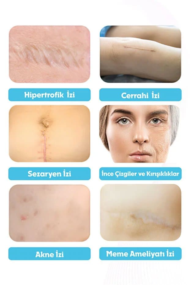 Premium Soft Silikon Yara İz Giderici Bandı %93 Etkili 2’li Set 6m - Keloid/Ameliyat/Sezaryen/Skar